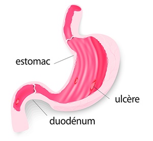 schéma d'un ulcère à l'estomac